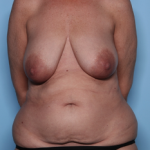 Mommy Makeover Before & After Patient #34313